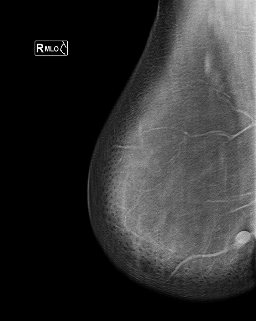 CATEGORIAS BI-RADS v2025 1.2.826.0.1.3680043.6.26182.39630.20240710160148.17628.1.5