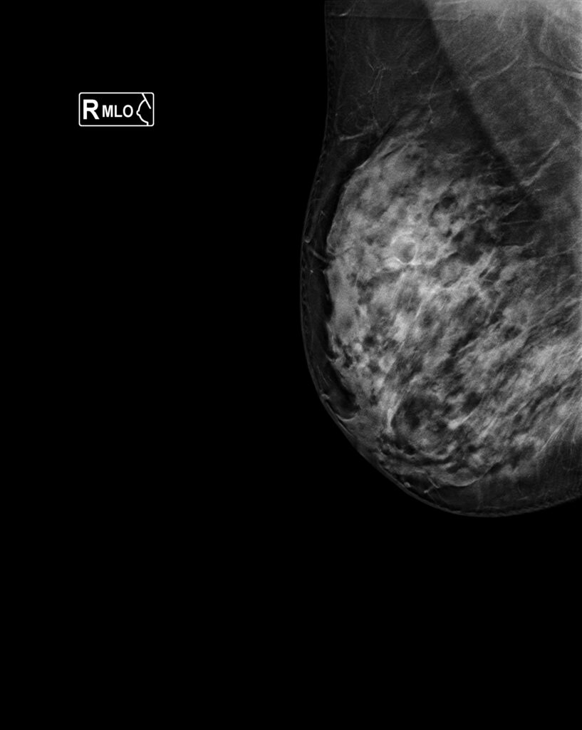 CATEGORIAS BI-RADS v2025 1.2.826.0.1.3680043.6.68123.11843.20240513160408.11752.1.4