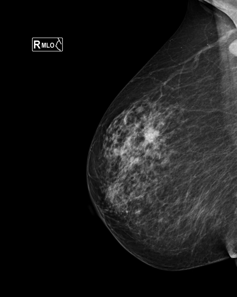 CATEGORIAS BI-RADS v2025 1.2.826.0.1.3680043.6.86473.16933.20250312181958.15368.1.14