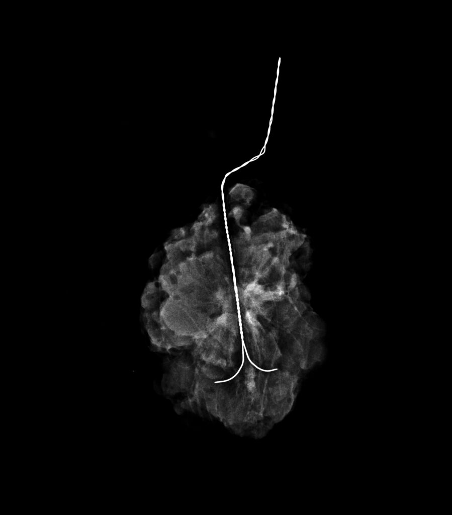 CATEGORIAS BI-RADS v2025 arpon mama