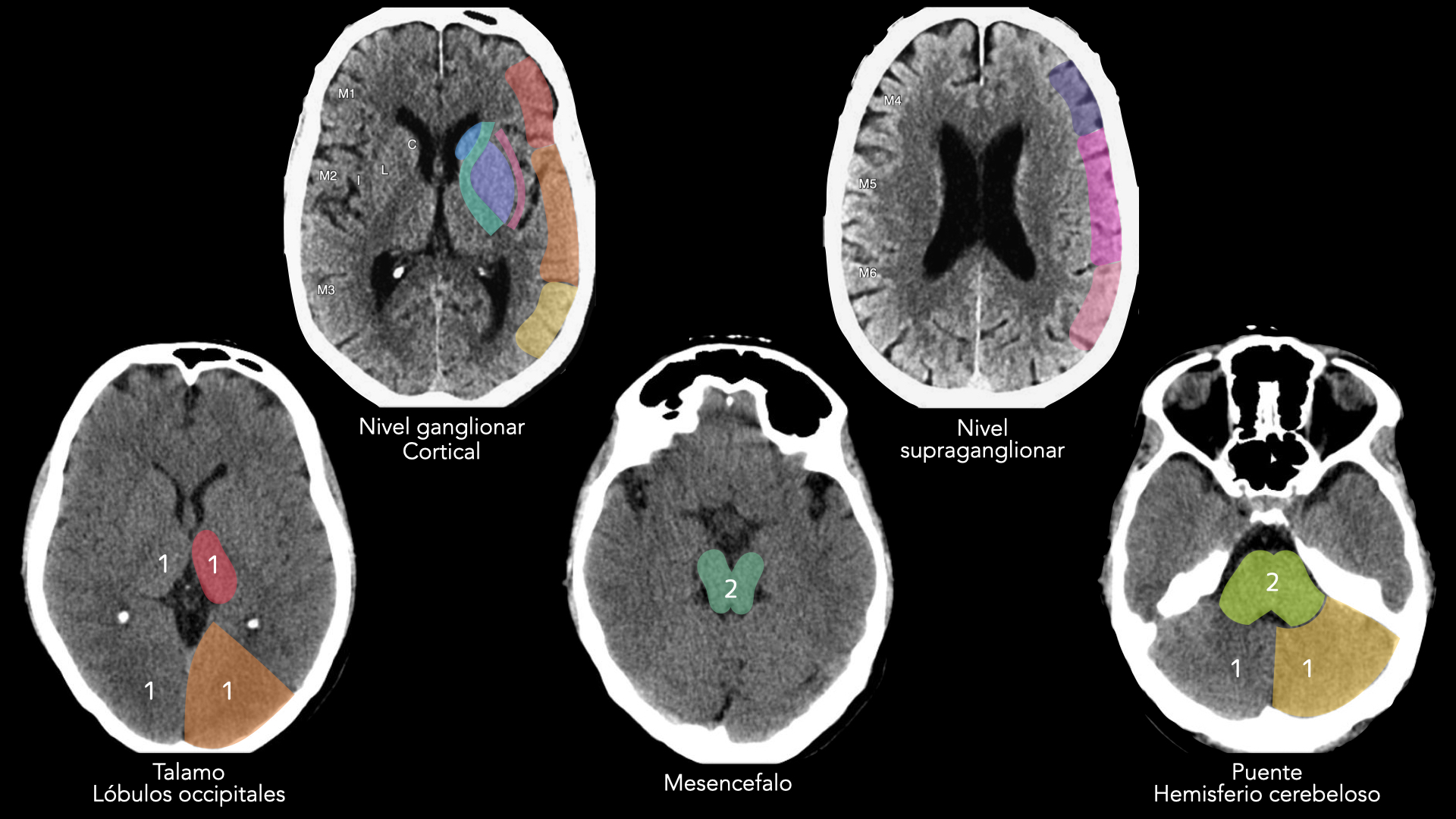 Mapa anatómico de territorios ASPECTS