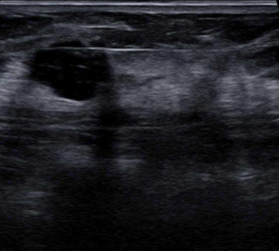 CATEGORIAS BI-RADS v2025 biopsia