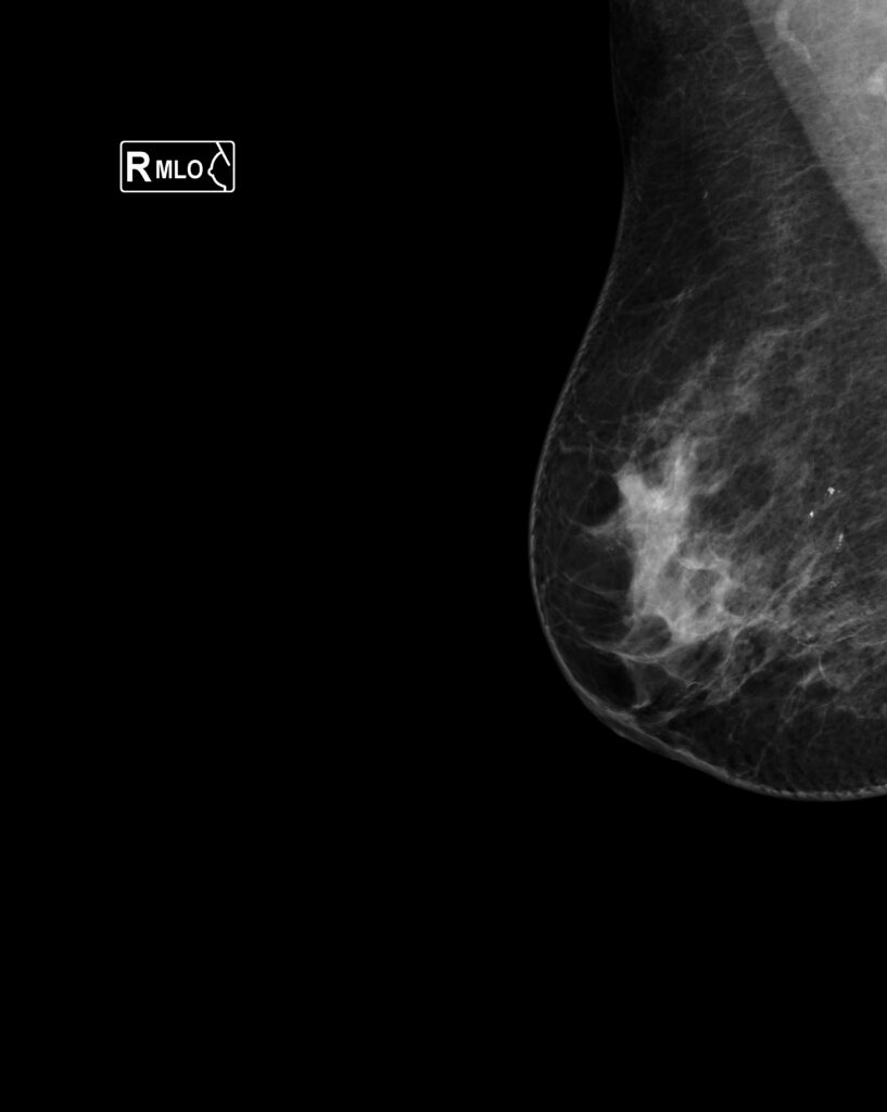 CATEGORIAS BI-RADS v2025 ca agrupadas 1