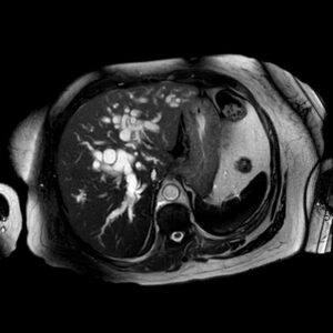 dilatacion de conductos biliares rmn ax