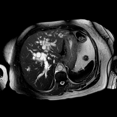 dilatacion de conductos biliares rmn ax