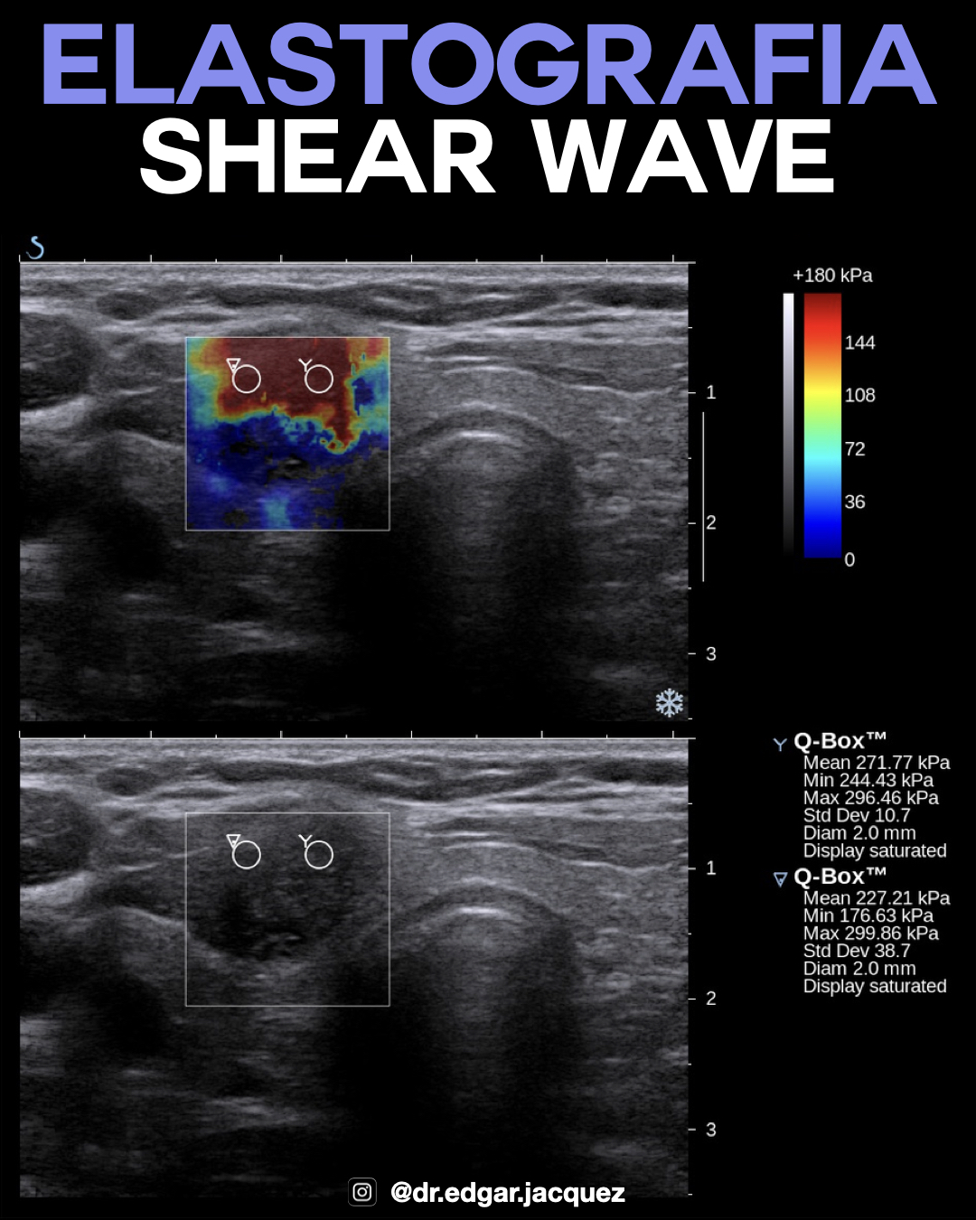 Cuantificación Shear Wave Elastography