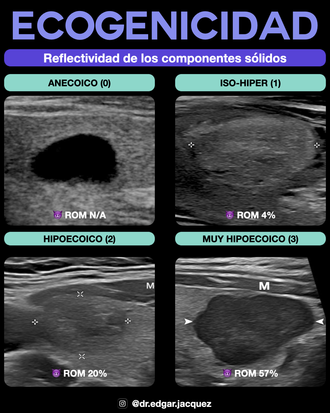 Ejemplo Ecogenicidad Muy Hipoecoico