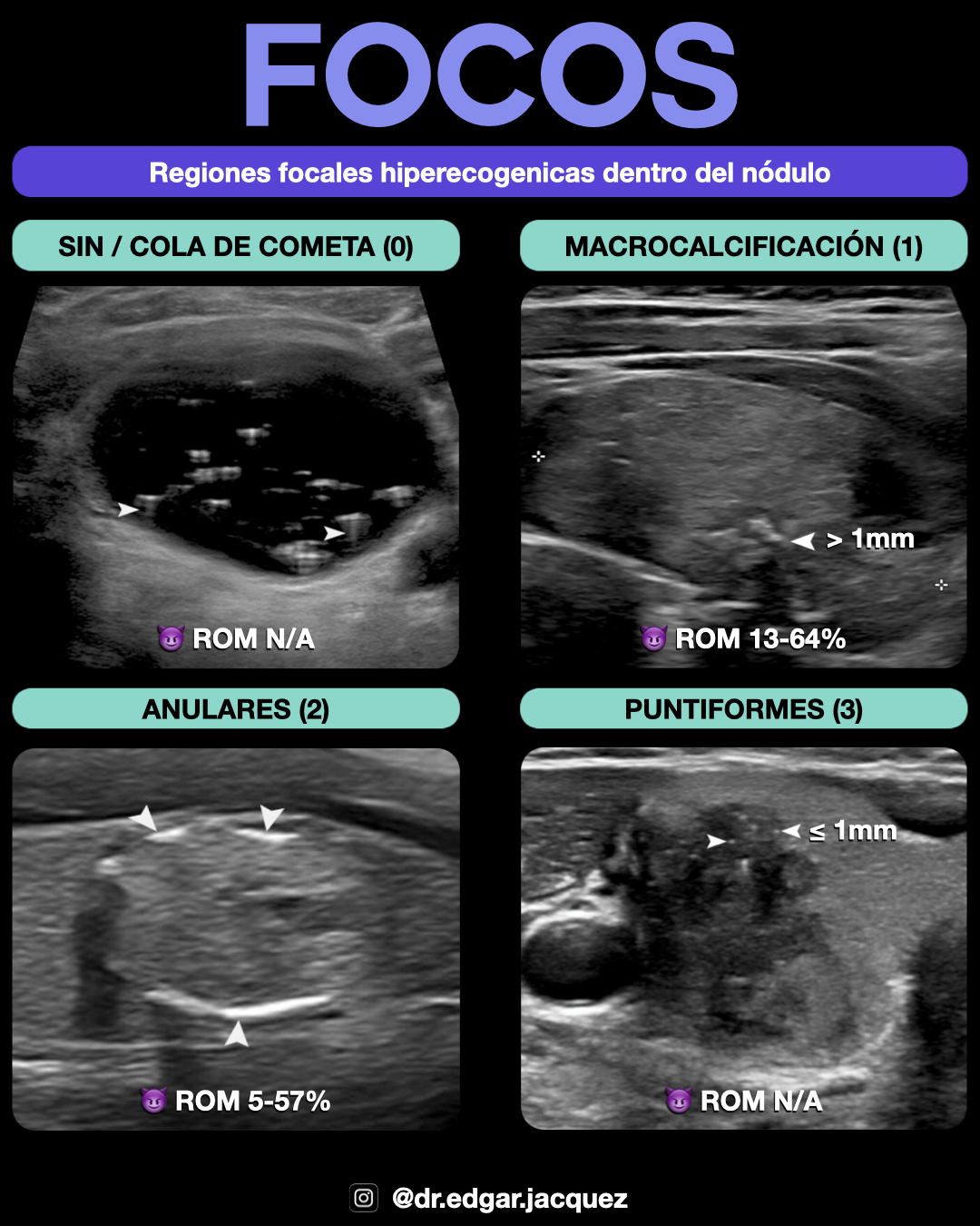Ejemplo Focos Ecogénicos Punteados