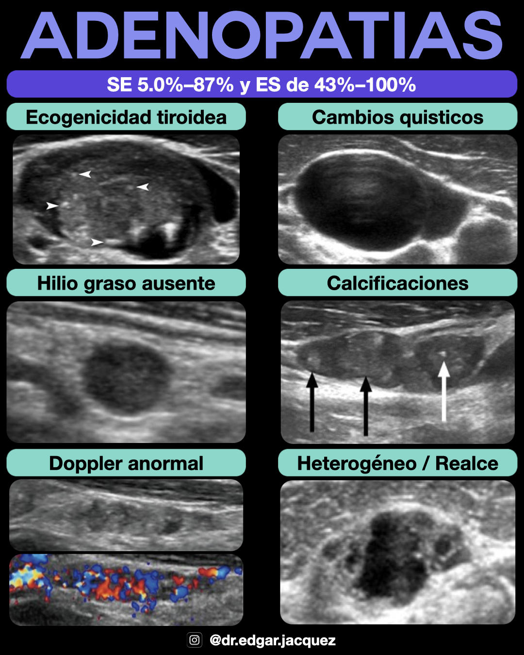Mapa de Niveles Ganglionares Cervicales