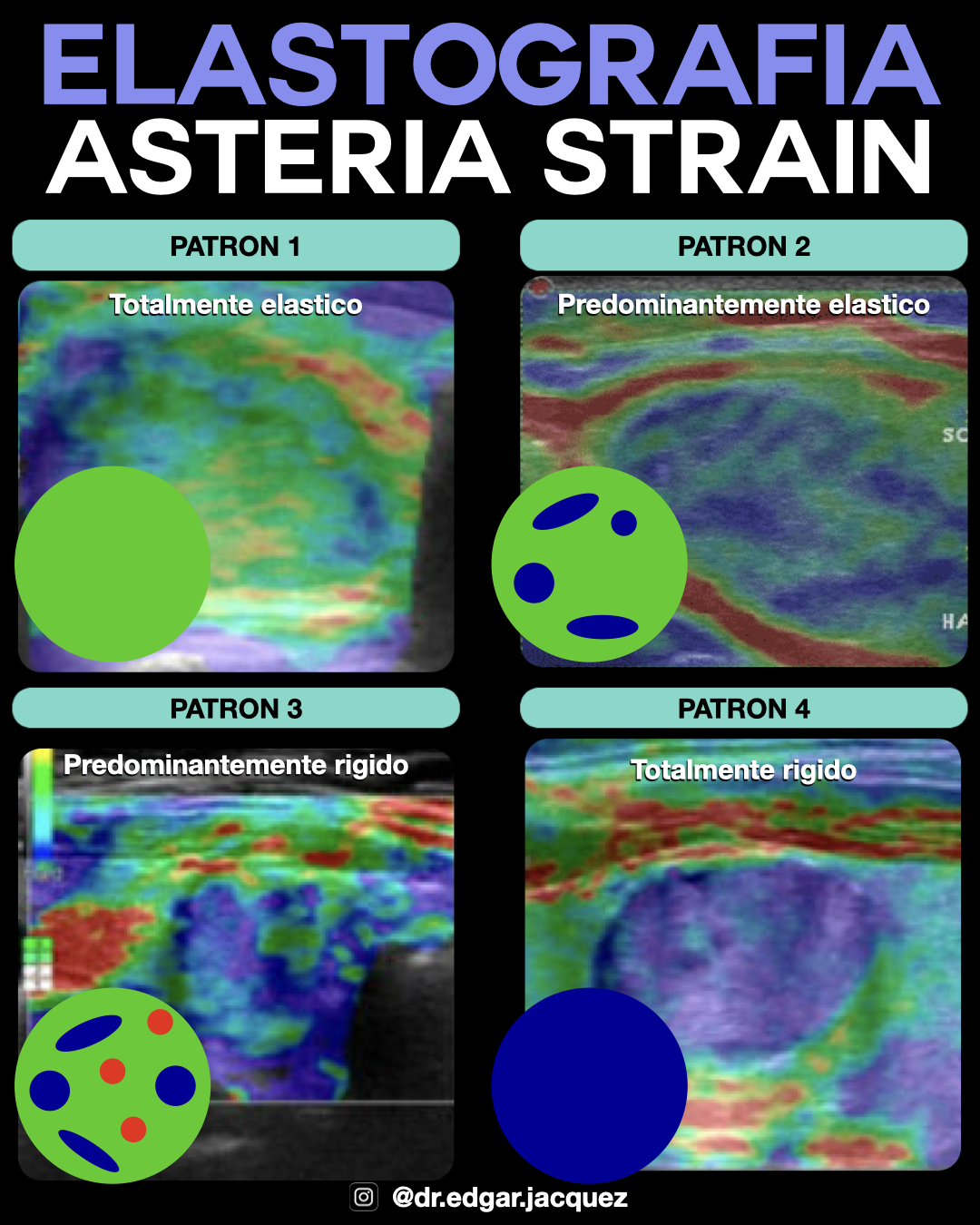 Mapa de Color Strain Elastography