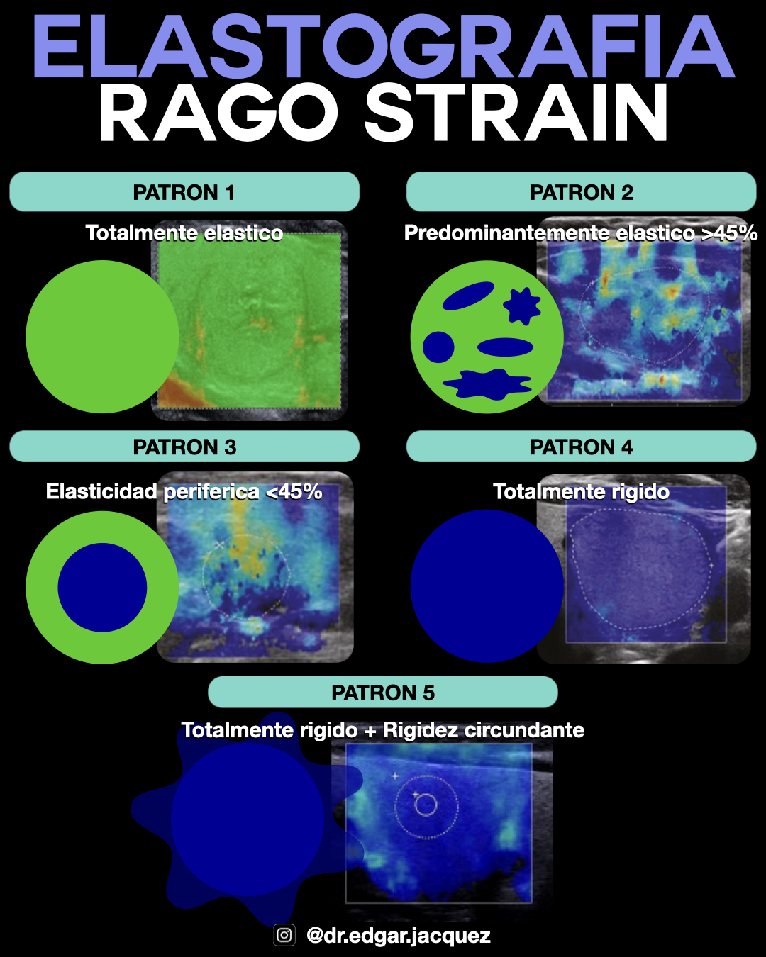 Mapa de Color Strain Elastography