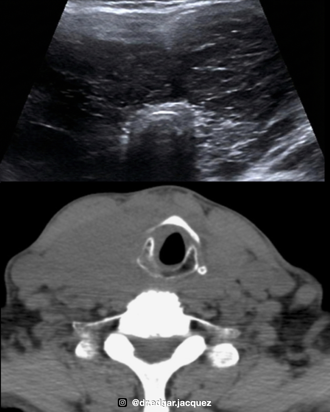 Linfoma Tiroideo: Masa Marcadamente Hipoecoica con Refuerzo Posterior