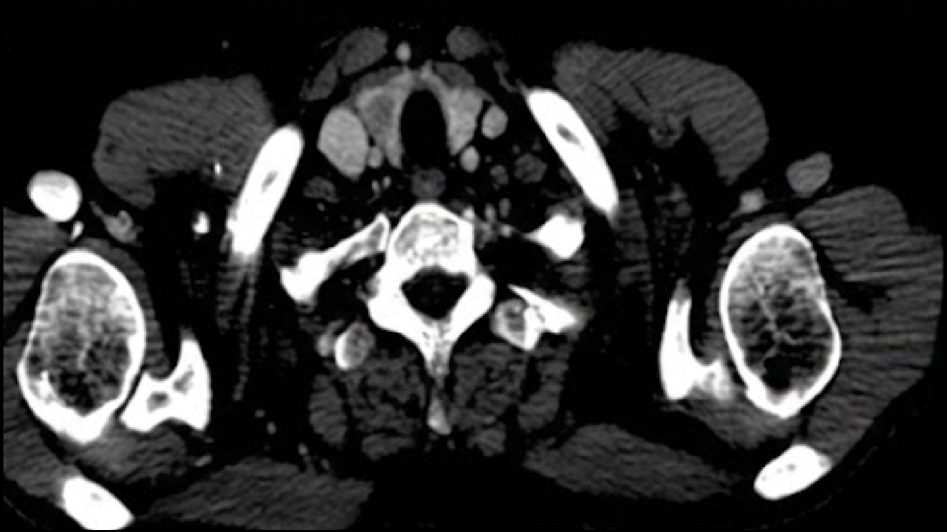 TC Cuello / Tiroides