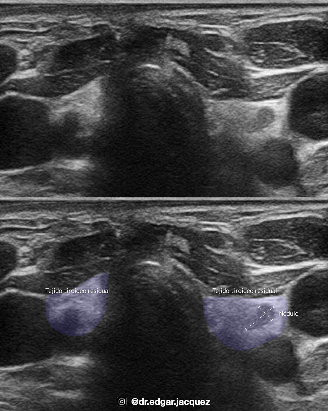 Recurrencia Nodular en Lecho Quirúrgico vs Tejido Cicatrizal Lineal