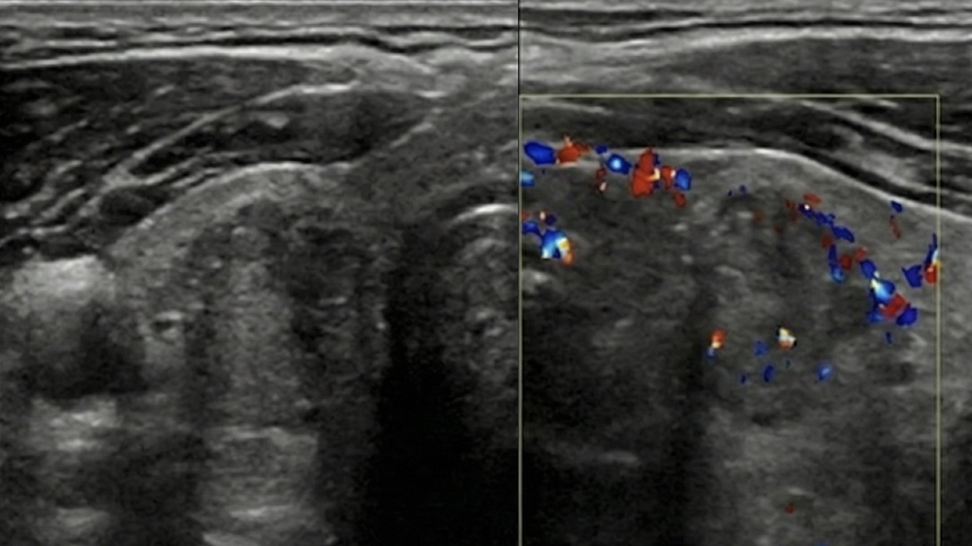 Hallazgos US Tiroideo